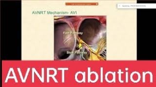 AVNRT ablation  AV nodal reentry tachycardia EPStudy Electrophysiology by DrNarendraKumar [upl. by Araccat427]