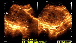 Understanding Large Intramural Fibroids Diagnosis and Management [upl. by Enyaz]