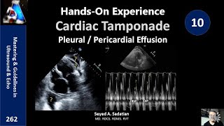 HandsOn Experience 10 Cardiac Tamponade Pleural  Pericardial Effusion [upl. by Fitts]