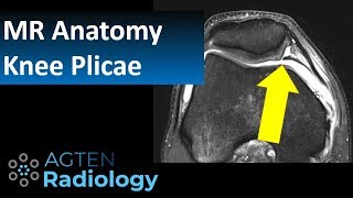 MRI Anatomy of Knee Plicae [upl. by Arleyne950]