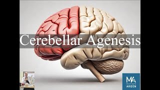 Cerebellar Agenesis [upl. by Radke957]