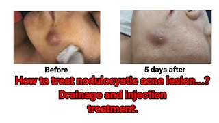 NoduloCystic Acne Treatment Injection Therapy DrArifMDDermatologist NodularAcne acnetreatment [upl. by Kalfas]