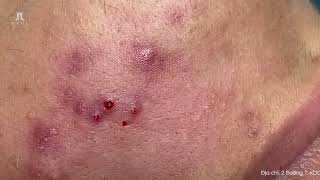 Big Cystic Acne Blackheads Extraction Blackheads amp Milia Whiteheads Removal Pimple Popping [upl. by Ylrebmik]