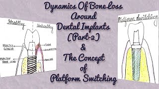 Dynamics of Bone Loss around Dental Implants Part2Biologic WidthPlatform Switching [upl. by Annairba]