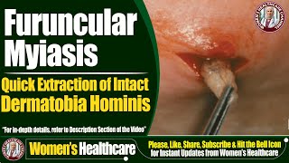 Furuncular Myiasis  Quick Extraction of Intact Dermatobia Hominis  Womens Healthcare [upl. by Llenod]