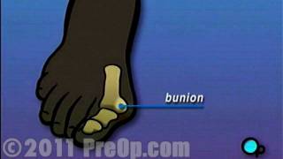 Bunion Removal Foot Surgery PreOp® Patient Education HD [upl. by Jollanta]