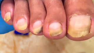 Long toenail trim pedicure done in 2 minutes [upl. by Dorette]