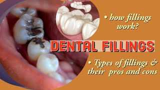 What are Dental fillings How fillings work Types of filling materials and their pros and cons [upl. by Nueoras]