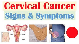 Cervical Cancer Signs amp Symptoms amp Why They Occur [upl. by Aldis]