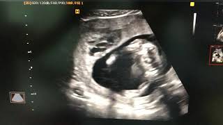 Subchorionic and retroplacental hematoma ultrasound sonography [upl. by Balbur]