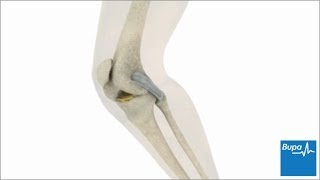 How knee arthroscopy is carried out  Bupa Health [upl. by Kalam350]