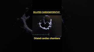 Dilated Cardiomyopathycardiomyopathymyocarditisechoheartfailure heartfunctionpericarditis [upl. by Burty]