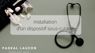 Installation dun dispositif souscutanée [upl. by Kesia]