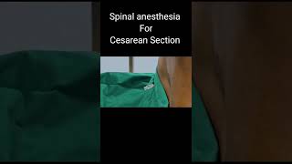 Spinal Anesthesia in Cesarean  OT stories  YouTubeShorts [upl. by Lashondra666]