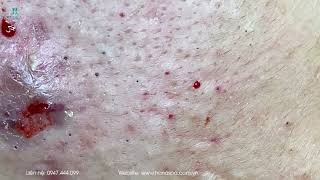 Big Cystic Acne Blackheads Extraction Blackheads amp Milia Whiteheads Removal Pimple Popping [upl. by Lyndsay824]