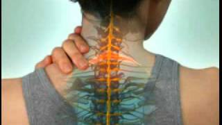 Cervical Radiculopathy  DePuy Videos [upl. by Niledam]