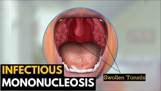 Infectious mononucleosis Causes Signs and Symptoms Diagnosis and Treatment [upl. by Ewell]