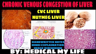 CVC LIVER  NUTMEG LIVER  Hemodynamic Disorder I Pathology [upl. by Fina]