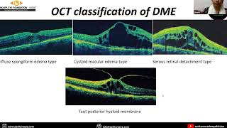 Diabetic macular edema Pathophysiology Diagnosis and management [upl. by Ehc]