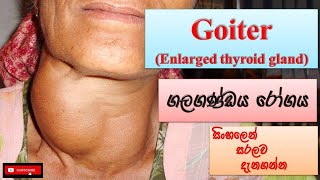 Goiter ගලගණ්ඩය රෝගය how it happens causes symptoms treatments how to prevent [upl. by Eimmot]