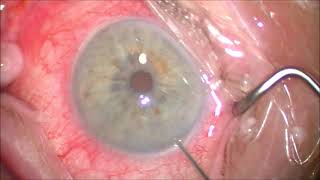 Removal of Durysta Implant from Eye [upl. by Aivonas]