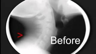 Neck Treatment under Motion X ray with the Arthrostim [upl. by Searby]