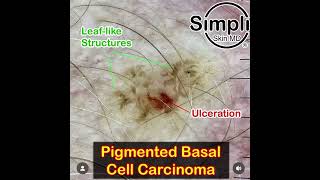 Pigmented Basal Cell Carcinoma Dermoscopy [upl. by Erhart]