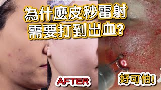 皮秒雷射治療痘疤打到出血好恐怖！莊盈彥醫師操作皮秒雷射非常專業！Shorts [upl. by Nnaeerb]