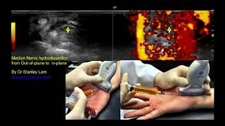 Ultrasoundguided nerve hydrodissection for pain management – Supplementary video 8 ID 247208 [upl. by Edylc]