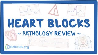 Heart blocks Pathology Review [upl. by Darlene]