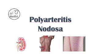 Polyarteritis Nodosa PAN  Signs amp Symptoms Diagnosis Treatment [upl. by Madalyn]