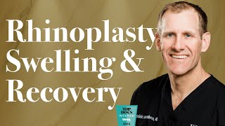 Rhinoplasty Swelling Stages And Recovery [upl. by Spark]