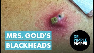 Mrs Golds Back Blackhead Extraction Session  Addressing the Inflamed One [upl. by Linette858]