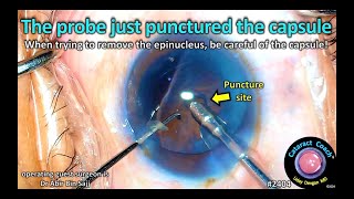 CataractCoach™ 2404 the probe just punctured the posterior capsule during epinucleus removal [upl. by Huang]