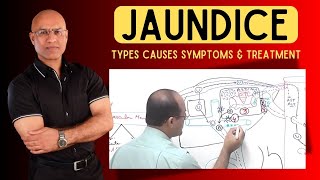 Jaundice  Types Causes Symptoms and Treatment [upl. by Akilat538]