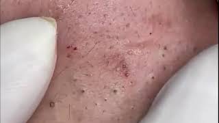 blackhead extractions new  remove blackheads dermatologist 27 [upl. by Naamana]