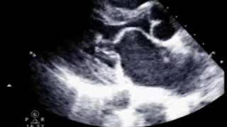 Mitral Stenosis  Echo Clip [upl. by Adnamas779]