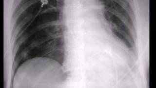 Chest xray Pneumothroax on a supine film [upl. by Bast137]