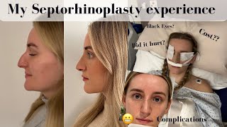 My Septorhinoplasty Experience amp complication FIRST 3 WEEKS [upl. by Pacifica448]