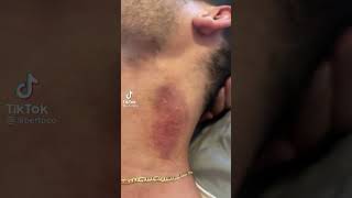 How to get rid of a hickey [upl. by Adran]