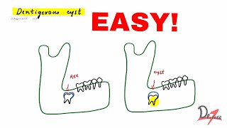 Dentigerous cyst made easy [upl. by Annatnom929]