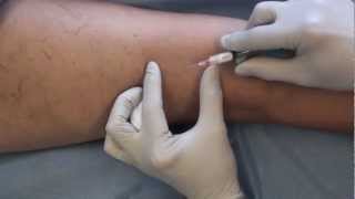 SyrEase Foam Sclerotherapy [upl. by Ennalorac]