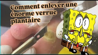 Comment enlever une énorme verrue plantaire [upl. by Amelus]