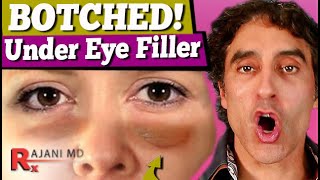 BOTCHED UNDER EYE FILLER  Under Eye Filler [upl. by Buckler]