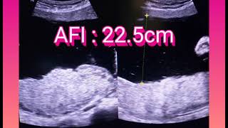 Heartbeat Ultrasound  Increase Heart Rate BoyGirl  Fetal Tachycardia  Liquor Adequate Increased [upl. by Einhpets]