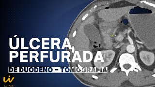 ÚLCERA PERFURADA DUODENAL [upl. by Felipe]