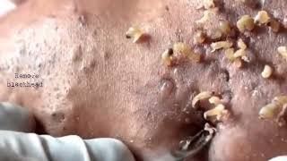 Acne amp Blackhead Treatment on his foreheadBlackhead Removal on forehead  Remove Blackhead [upl. by Nerrad389]