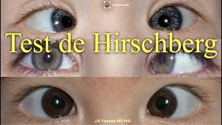 Test de Hirschberg [upl. by Ivar]