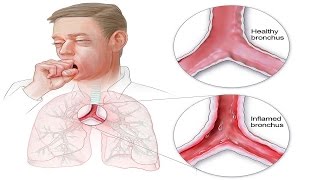 How to Get Rid of Bronchitis Naturally Best Home Remedies [upl. by Profant]