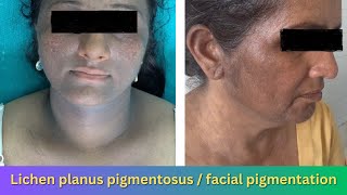 Lichen planus pigmentosus  facial pigmentation [upl. by Pachston]